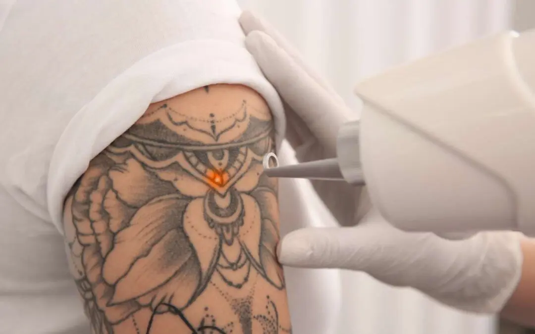 ¿Es posible borrar un tatuaje por completo con tecnología láser?